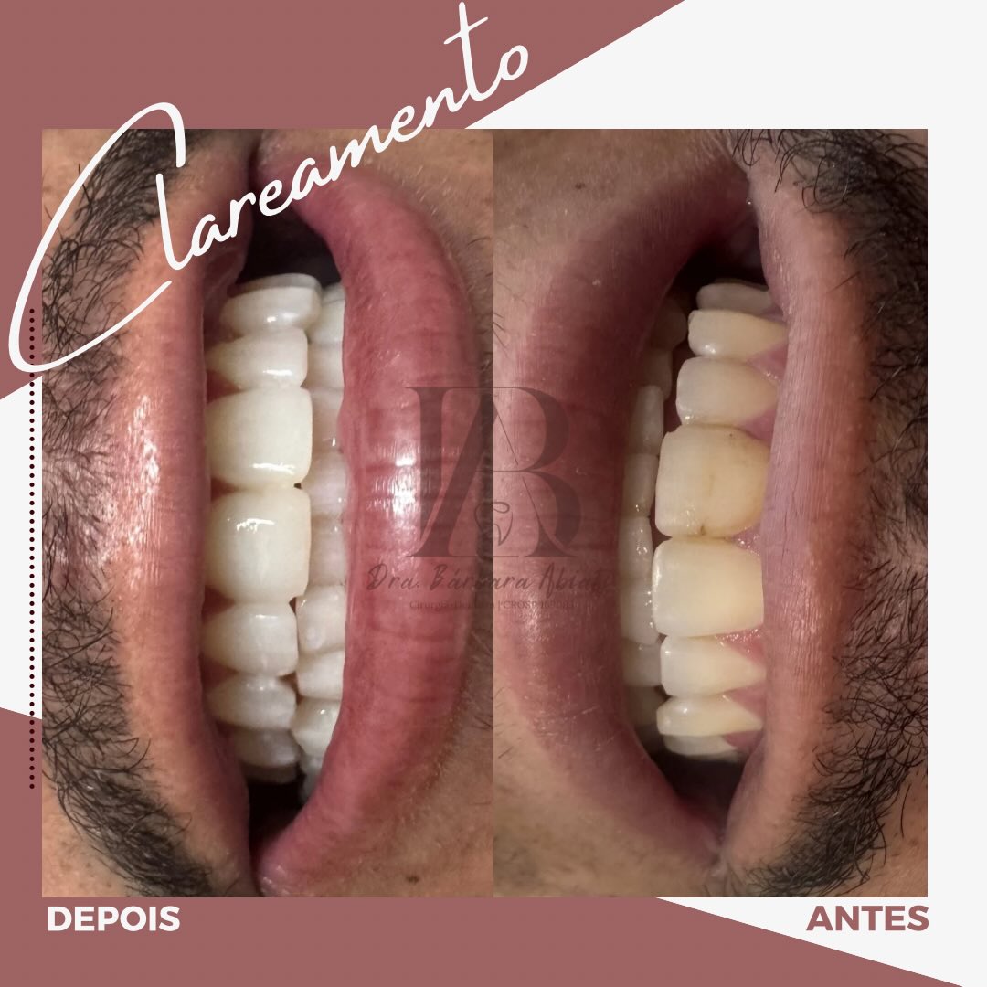 Antes e depois - Clareamento Dental