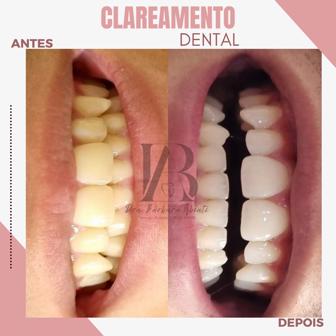 Antes e depois - Clareamento Dental